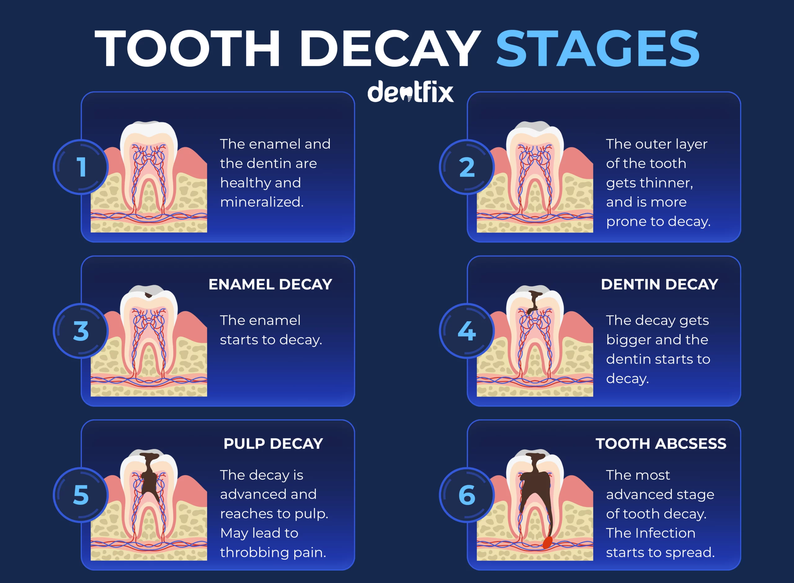 Tooth Decay Stages