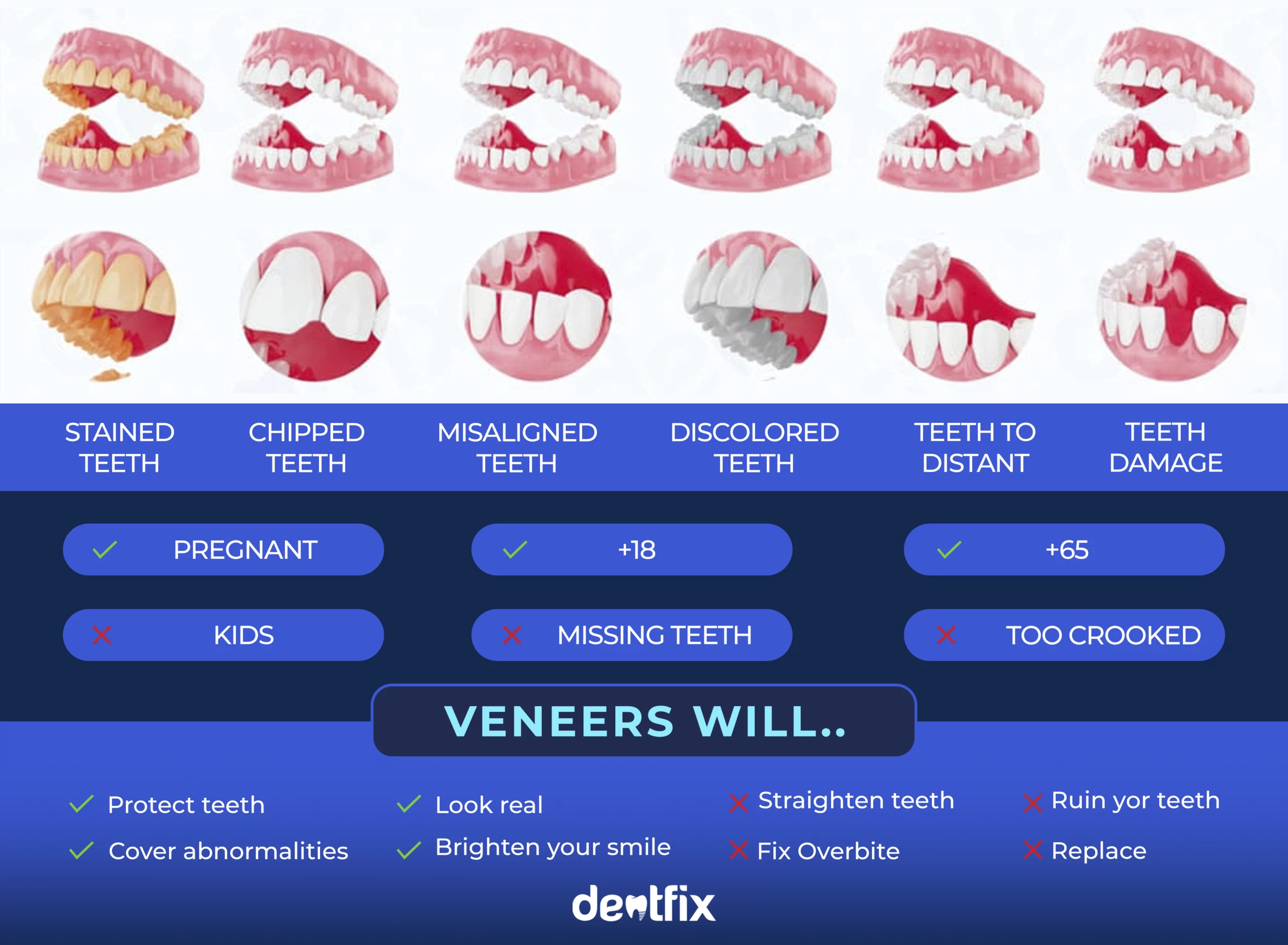 veneers